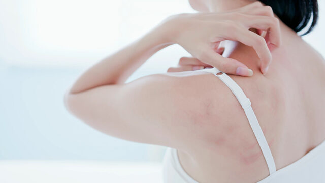 환절기 가려움증, 피부과 치료만이 정답일까? 건선·아토피 예방법 대공개!