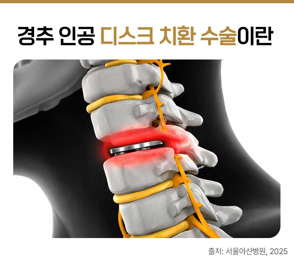 건강보험톡 목 디스크 경추 인공 디스크 치환 수술
