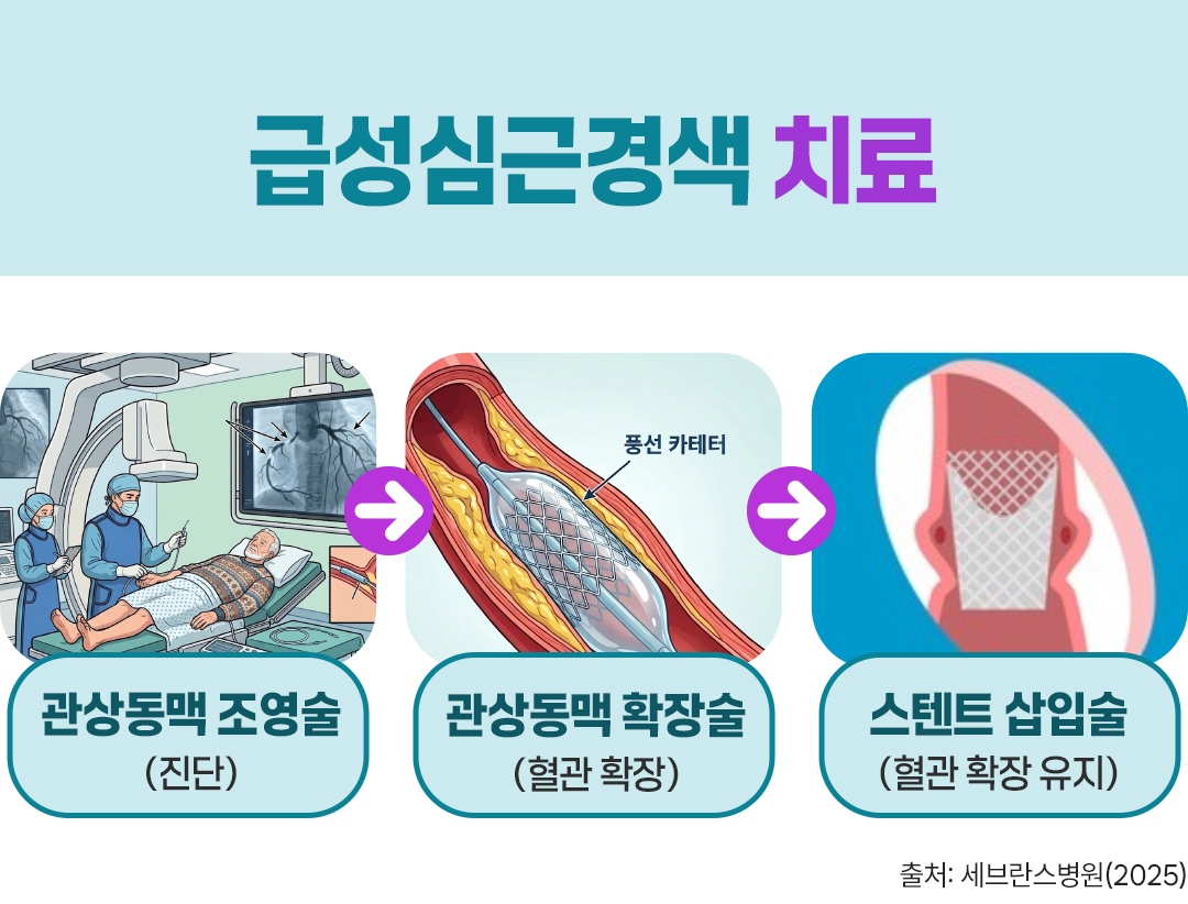 건강보험톡 급성심근경색 치료 관상동맥 조영술 관상동맥 확장술 스텐트 삽입술