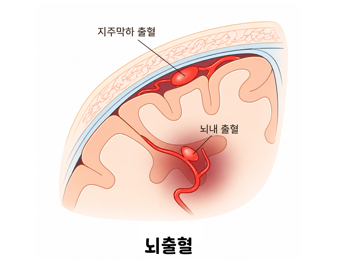 이런저런특약 뇌혈관